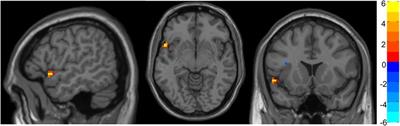 Spontaneous brain activity in healthy aging: An overview through fluctuations and regional homogeneity